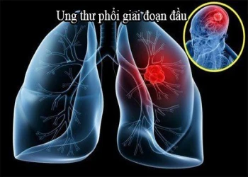 Những dấu hiệu, biểu hiện và triệu chứng ung thư phổi giai đoạn đầu